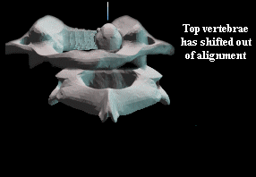 Vertebral subluxation