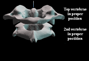 No vertebral subluxation